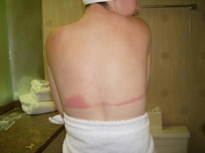 0508/Sunburn0506.jpg