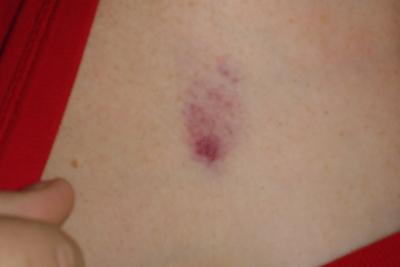 1109/Bruise1101.jpg