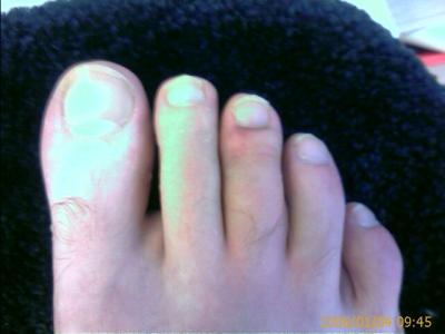smashedToe5552.jpg