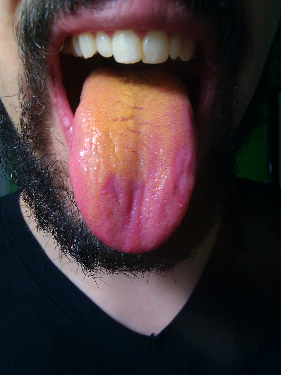 Acid reflux cause orange tongue